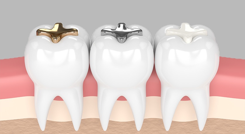 Dental Fillings
