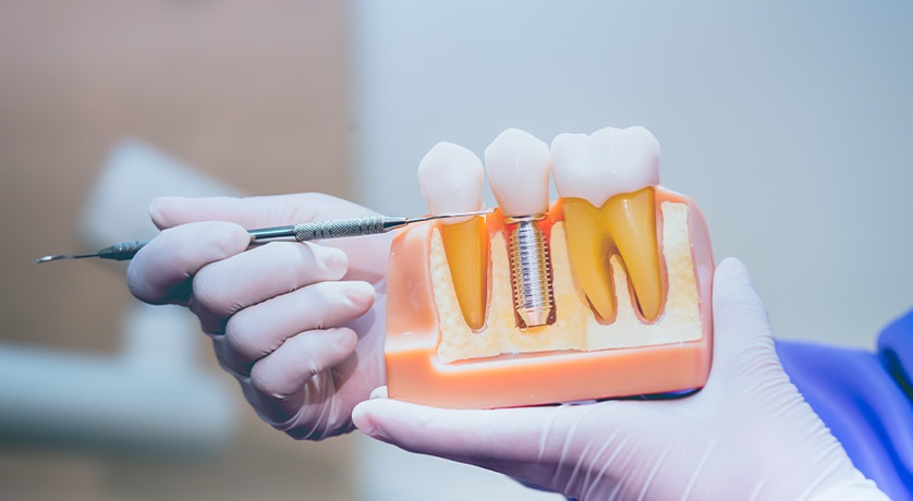 Dental Implants
