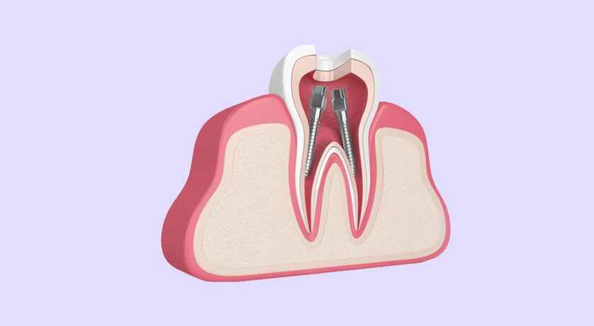 When Is a Root Canal Necessary? Understanding When to Seek Treatment