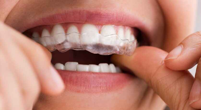 How Long Does It Take to Straighten Teeth with Braces?