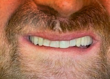 6-After